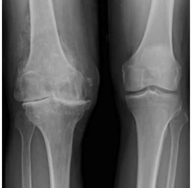 Osteoarthritis in the left knee